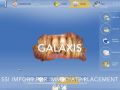 Galaxis Software - SSI Import: Immediate Implant Placement