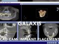 Galaxis Software - CAD CAM Tool - Implant Placement