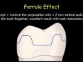 CEREC Preparations - Onlays - Ferrule Effect