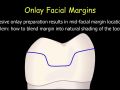 CEREC Preparations - Onlays - Esthetic Modification of the Facial Margin
