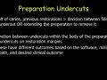 CEREC Preparations - Onlays - Preparation Undercuts