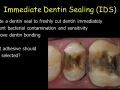Immediate Dentin Sealing: Adhesive Thickness