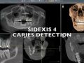 SIDEXIS 4: Caries Detection