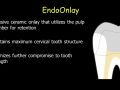 CEREC EndoCrowns - EndoCrown or EndoOnlay