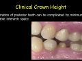 CEREC EndoCrowns - Crown Height