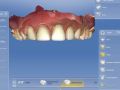 Using CEREC Guide 2 For Multiple Implant Sites