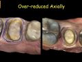 PBN Crown Prep Study - Occlusal and Axial Reduction