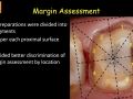 PBN Subgingival Margins Study - 3. Margin Assessment