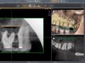 3. SICAT Endo - Diagnosis Phase - Aligning 2D Radiograph with CBCT Scan