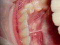 Solea Lingual Frenectomy - Dr. Heath Brantley