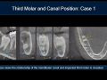 Applications for CBCT - Third Molars