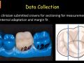 4. PBN Crown Occlusal Spacer Setting Study - Crown Spacer Data