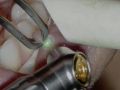 Fibroma removal - Dr. Jeffrey Rohde