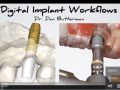 Digital Implant Workflows