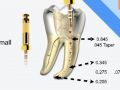 Endodontic Shaping - Reciprocation Technique
