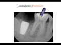 Endodontic Case 1 - Part 3 - Endodontic Procedure