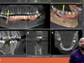 Tip of the Day - Implant Aligned View