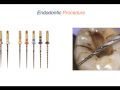 Endodontic Case 2 - Part 3 - Instrumenting Canal