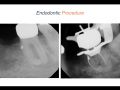 Endodontic Case 2 - Part 4 - Obturating Canals