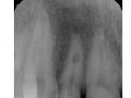 Endodontic Case 3 - Part 1 - Finishing a Previously Started Treatment
