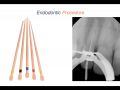 Endodontic Case 3 - Part 3 - ProTaper Treatment