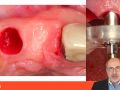 Tip of the Day - Astra EV Profile Implant Flapless Positioning