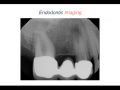 Endodontic Case 4 - Diagnosis