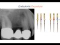 Endodontic Case 4 - Procedure