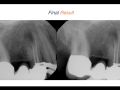 Endodontic Case 4 - Obturation