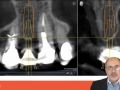 Tip of the Day - Astra EV Profile Implant Flapless Positioning
