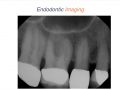 Endodontic Case 5 - Multiple Portals of Exit - Part 1