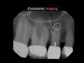 Endodontic Case 5 - Multiple Portals of Exit - Part 2