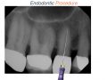 Endodontic Case 5 - Multiple Portals of Exit - Part 3