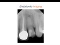 Endodontic Case 6 - Targeted Access - Part 1