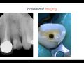 Endodontic Case 6 - Targeted Access - Part 2