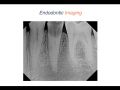 Endodontic Case 7 - Two Canal Premolar - Part 1