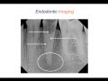 Endodontic Case 7 - Two Canal Premolar - Part 2