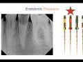 Endodontic Case 7 - Two Canal Premolar - Part 3
