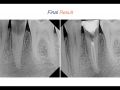 Endodontic Case 7 - Two Canal Premolar - Part 4