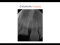 Endodontic Case 8 - Apexogenisis - Part 1