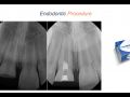Endodontic Case 8 - Apexogenisis - Part 3
