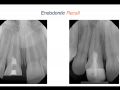 Endodontic Case 8 - Apexogenisis - Part 4