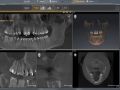 Implant Planning Two Congenitally Missing Laterals CT Phase