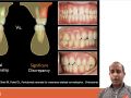 Tip of the Day - Alignment of Teeth and Attachment Loss