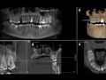 Using CBCT to Increase Case Acceptance & Patient Understanding