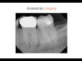 Endodontic Case 9 - Five Year Molar Recall - Part 1