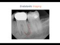 Endodontic Case 9 - Five Year Molar Recall - Part 2