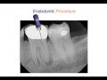Endodontic Case 9 - Five Year Molar Recall - Part 3