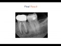 Endodontic Case 9 - Five Year Molar Recall - Part 4
