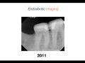Endodontic Case 10 - #30:31 - Part 1 - Diagnosis